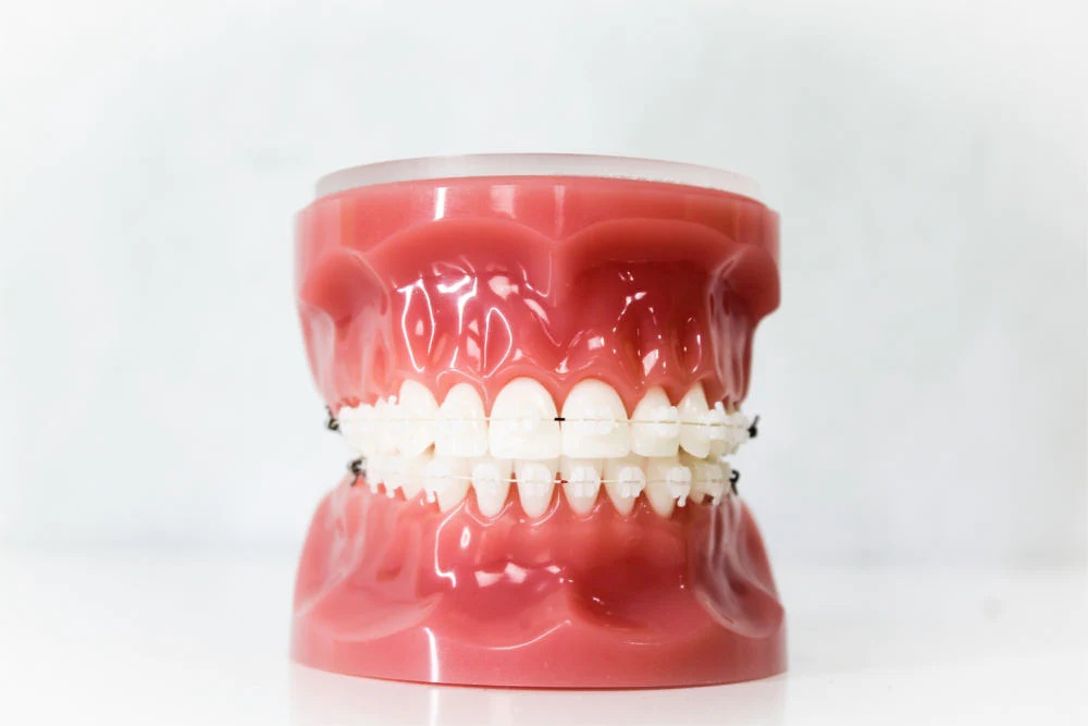 Elements Of The Orthodontic Treatment