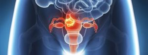 What Is The Main Cause Of Endometriosis?