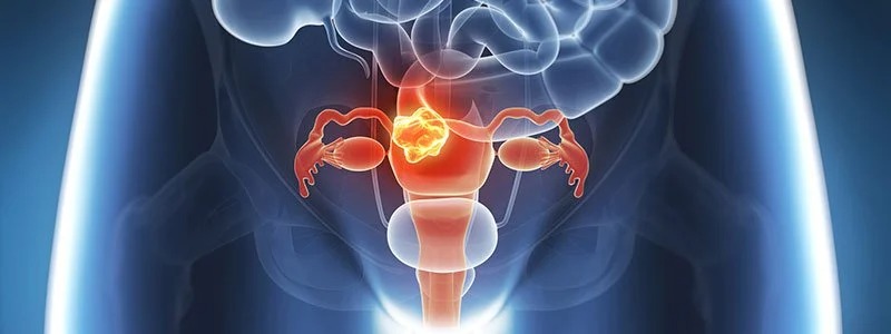 What Is The Main Cause Of Endometriosis?